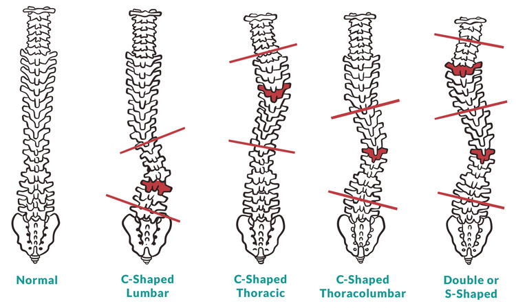 The 4 Scoliosis Curves The 4 Scoliosis Curves