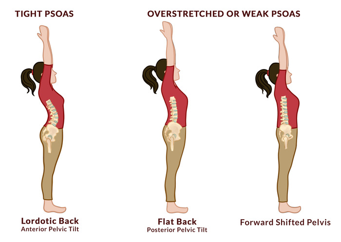 Pelvis out of alignment - anterior pelvic tilt, posterior pelvic tilt and forward shifted pelvis Pelvis out of alignment - anterior pelvic tilt, posterior pelvic tilt and forward shifted pelvis